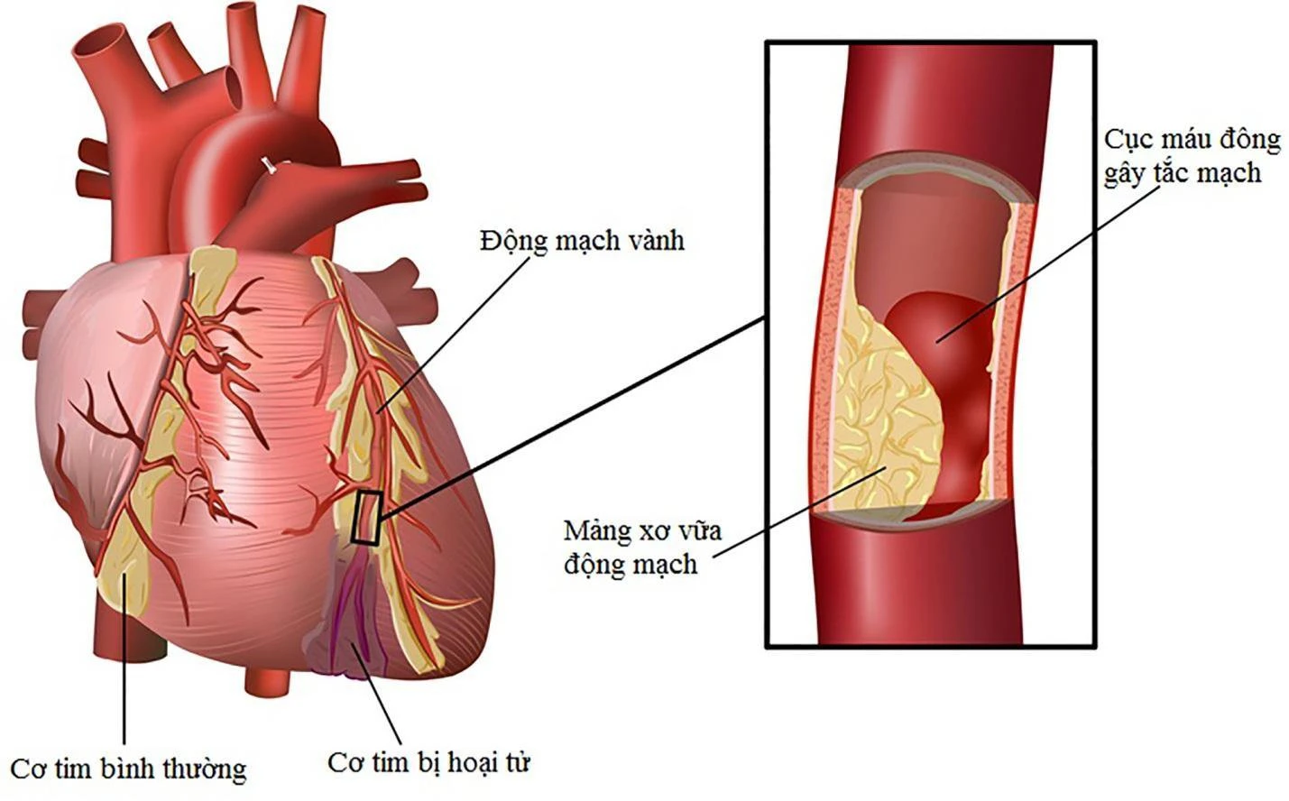Nguy cơ đột tử từ việc nhồi máu cơ tim cấp ở việt Nam